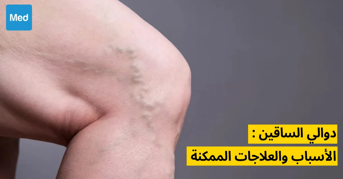 دوالي الساقين : الأسباب والعلاجات الممكنة